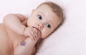 Congenital Birthmarks