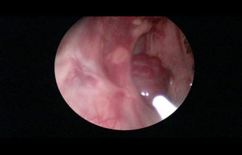 Venous malformation of the oropharynx treated with a Nd:YAG laser via a quartz fiber.
