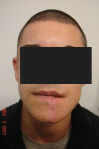 After - A patient with an AVM of his lower lip and chin.