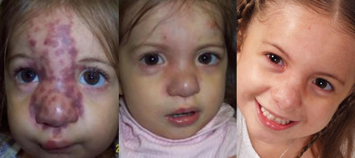 three photos of a girl: before, shortly after and a some time after arterio-venous malformation laser treatment