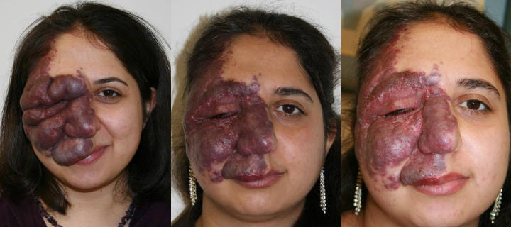 three photos of a teenage girl: before, shortly after and some time after facial port wine stains cheek excision and laser treatment