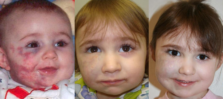 three photos of a baby girl : before, shortly after and some time after facial venous malformation laser treatment