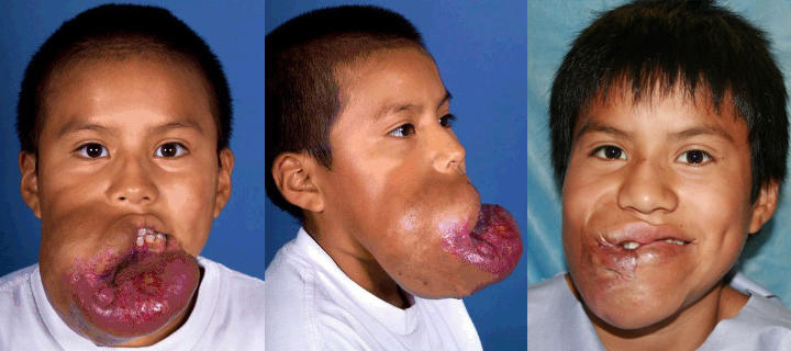 three photos of a boy: before and some time after cheek and neck venous malformation surgery