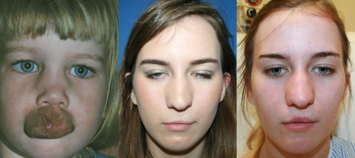 three photos of a girl: before, 14 and 18 years after lip arterio-venous malformation excision