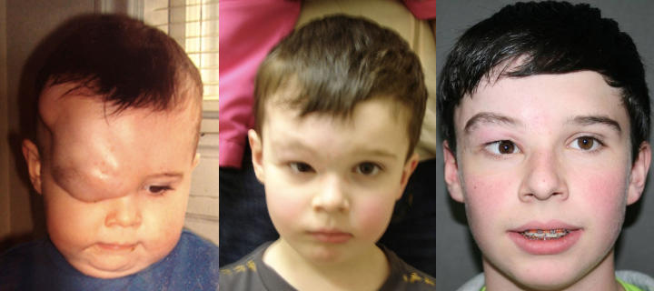 three photos of a boy: before, shortly after and some time after forehead lymphatic malformation excision