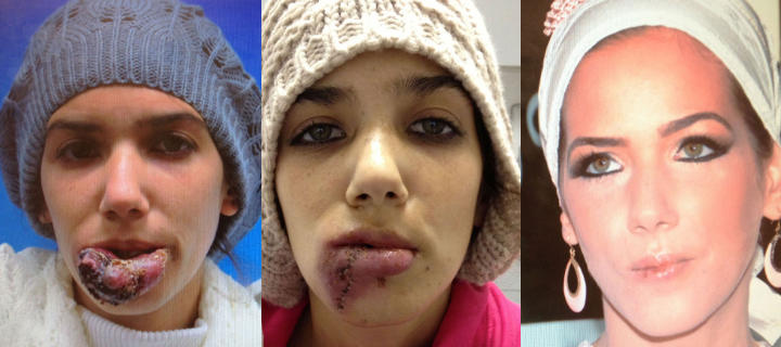 three photos of a teenage girl: before, one week post surgery and one year after lip arterio-venous malformation excision