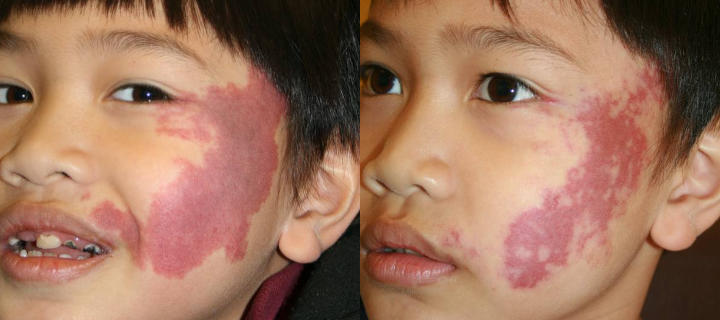 three photos of an Asian little boy: before and after several facial port wine stains laser treatments