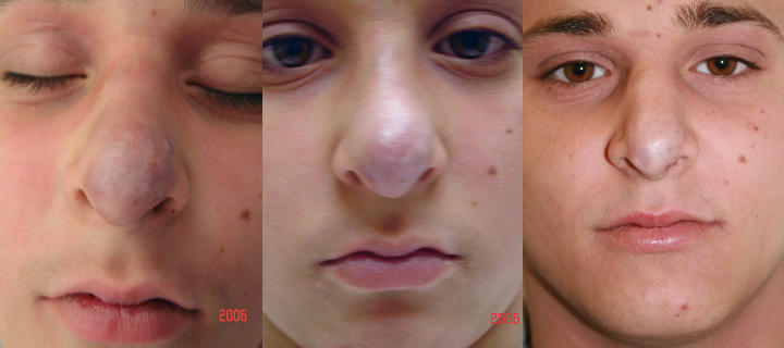three photos of a teenage boy: before, shortly after and some time after nose venous malformation excision